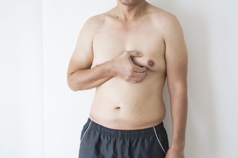 GYNECOMASTIA