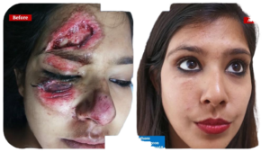 Facial Trauma Surgery Bhopal