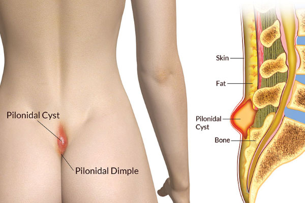 Pilonidal Sinus Treatment in Bhopal