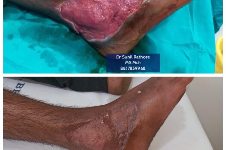 Diabetic Foot Surgery Bhopal