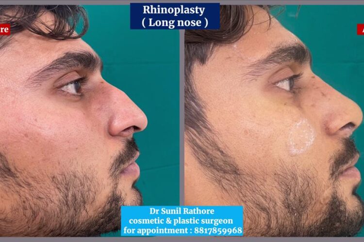 Rhinoplasty Surgery in Bhopal