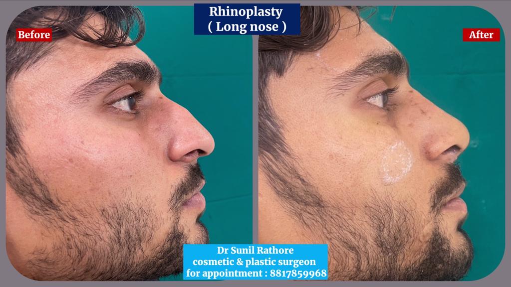 Rhinoplasty Surgery in Bhopal