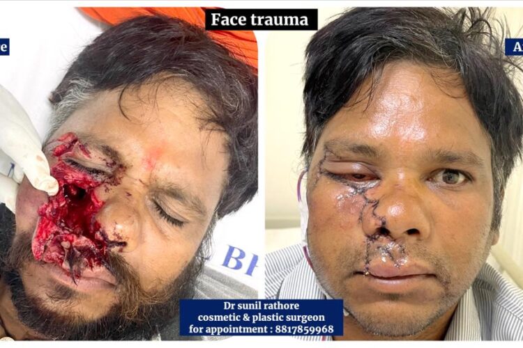 Facial Trauma Surgery in Bhopal