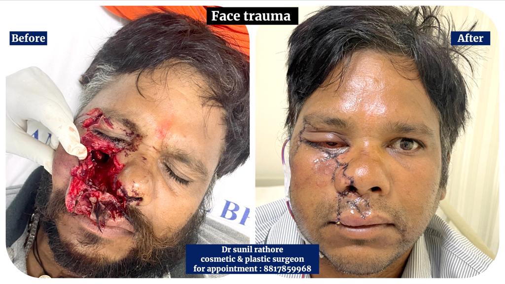 Facial Trauma Surgery in Bhopal