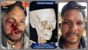 Orbital Fracture Repair Surgery Bhopal
