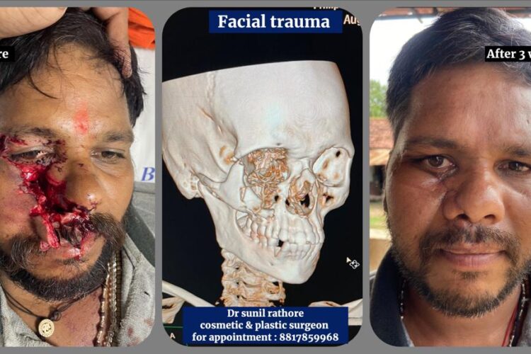 Orbital Fracture Repair Surgery Bhopal