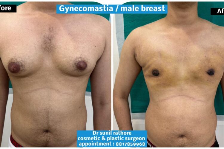 Gynecomastia: A Quick Guide to Understanding and Addressing It